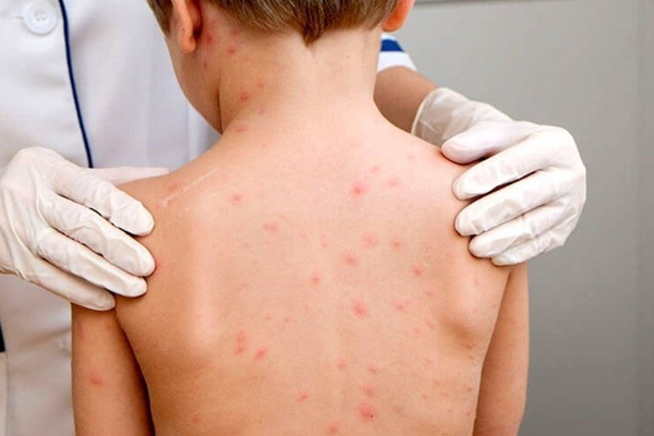 TWO MORE CASES OF MEASLES CONFIRMED AT THE CENTER FOR UKRAINIAN REFUGEES IN CHISINAU